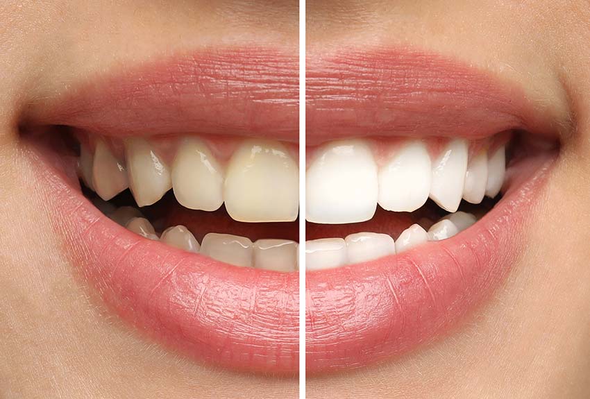 Close up of a woman's mouth showing before and after a teeth whitening procedure