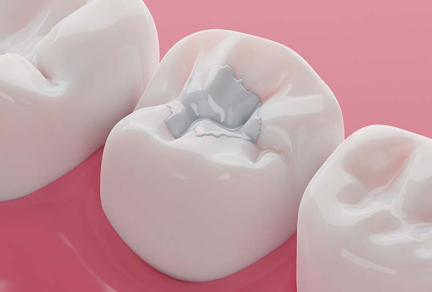 3-D close up of a cavity after being filled