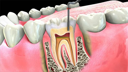 Root Canal Therapy in Guntersville, Albertville, Arab and nearby areas.