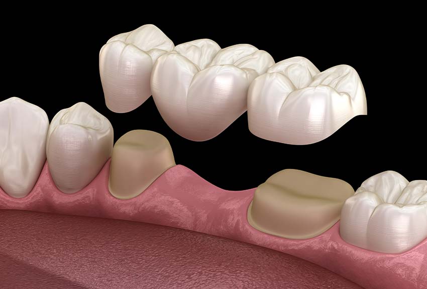 3-D closeup of a porcelain fixed bridge being attached