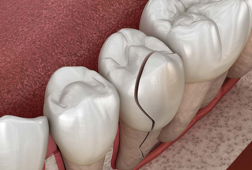 3-D model of a cracked tooth