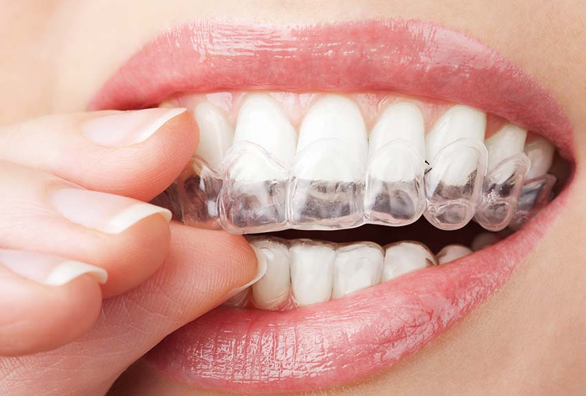 close-up of teeth whitening tray being applied
