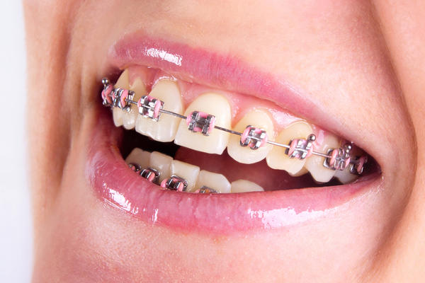 Orthodontic Braces
