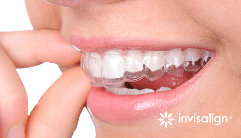 Invisalign® Clear Aligners