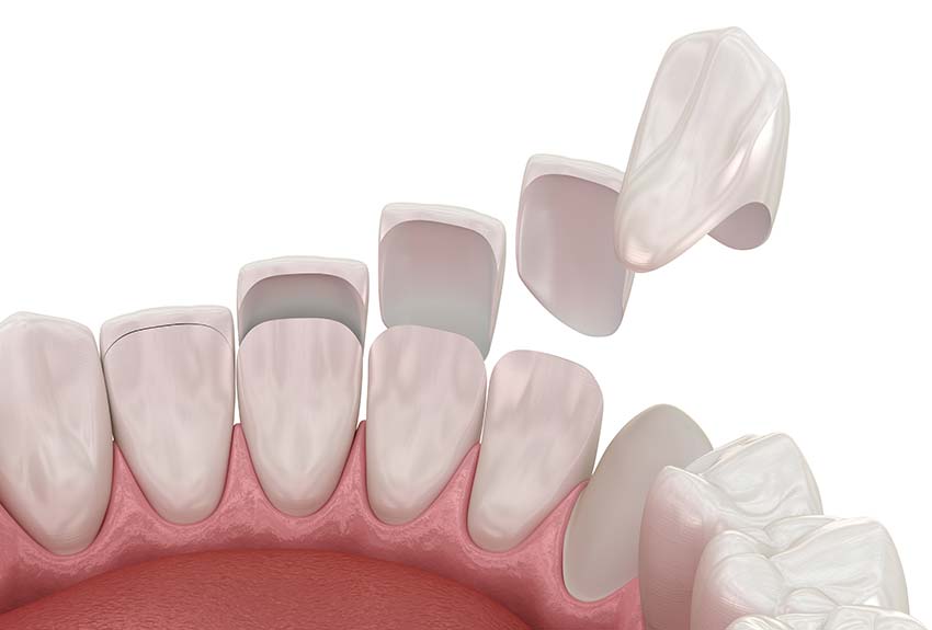 close-up of a 3-D rendering of how porcelain veneers are attached
